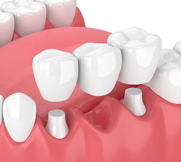 illustration of dental crown