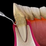 gum disease treatment, periodontal disease, Ryan Dental, Olathe KS dentist, Dr. William Ryan, Dr. Randy Regier, Dr. Katie Walker, scaling and root planing, laser gum therapy, periodontal maintenance, oral hygiene, healthy gums