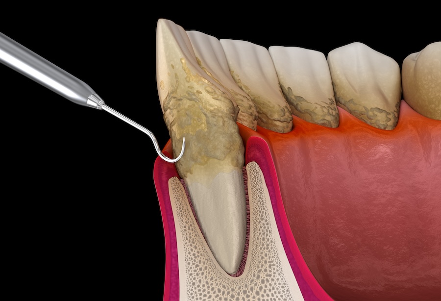 gum disease treatment, periodontal disease, Ryan Dental, Olathe KS dentist, Dr. William Ryan, Dr. Randy Regier, Dr. Katie Walker, scaling and root planing, laser gum therapy, periodontal maintenance, oral hygiene, healthy gums