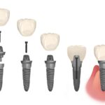 loose dental implant, dental emergency, dental implants Olathe KS, implant complications, Ryan Dental, dentist in Olathe