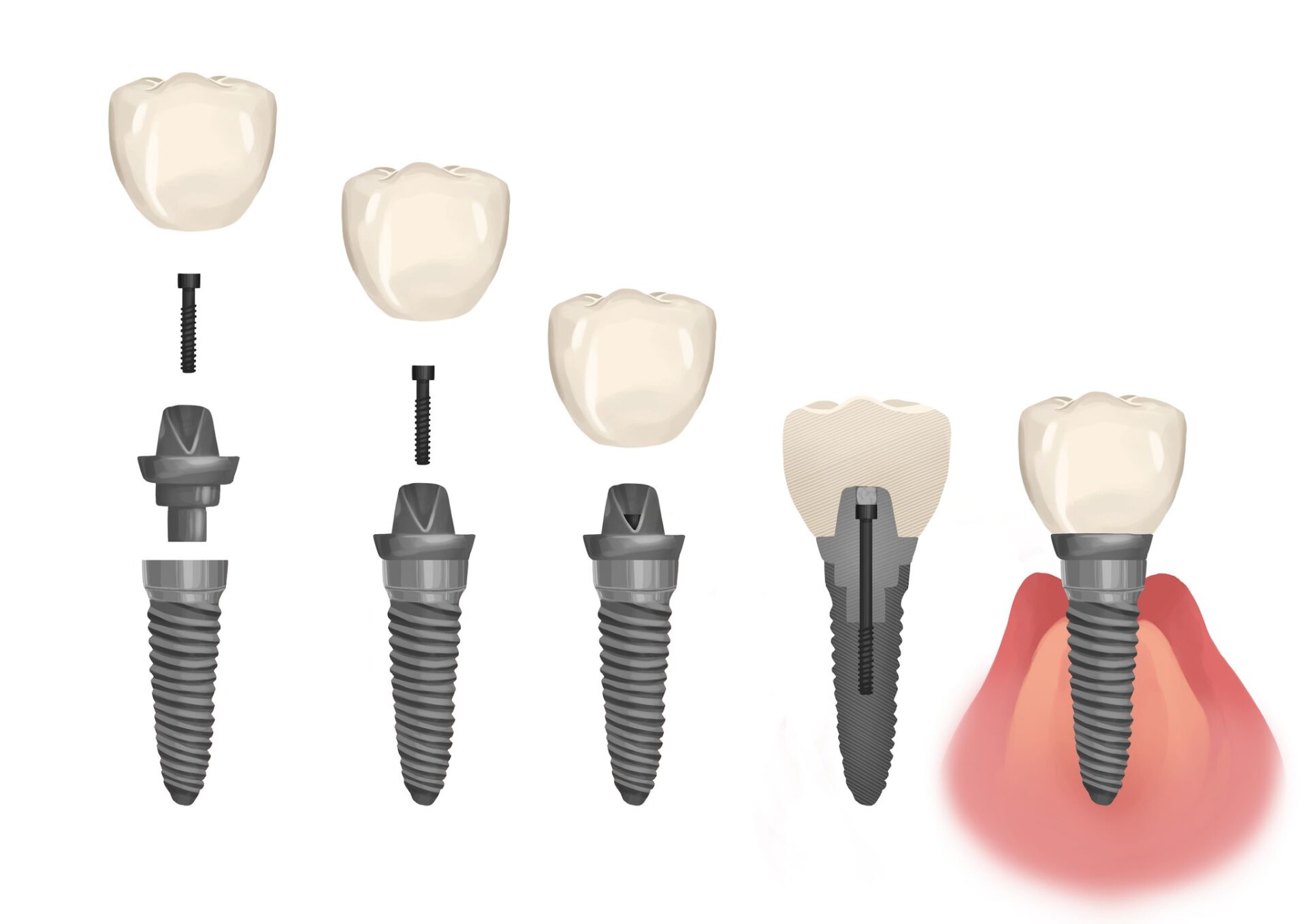 loose dental implant, dental emergency, dental implants Olathe KS, implant complications, Ryan Dental, dentist in Olathe