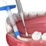 Medically accurate graphic illustration of a bone graft procedure, showing how bone material restores jawbone density to support dental implants and improve oral health.