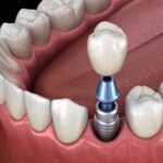 dental implant in lower arch, other options are dentures