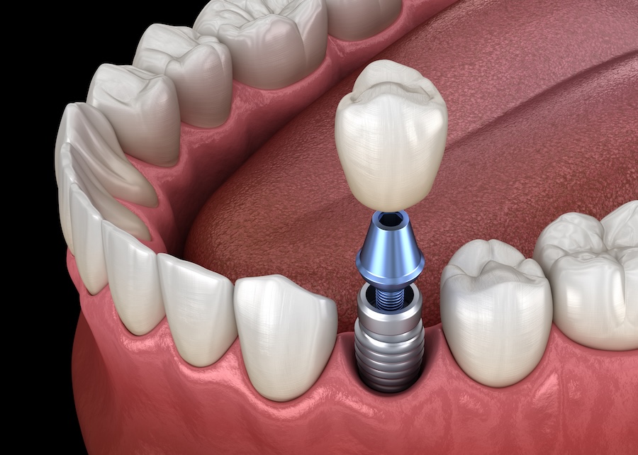 dental implant in lower arch, other options are dentures