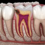 causes of cavities on a molar tooth