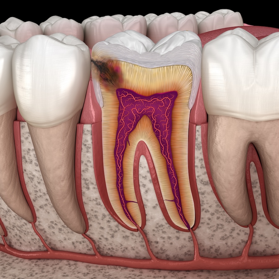 causes of cavities on a molar tooth