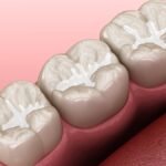 dental sealants on mandibular molar teeth to prevent cavities