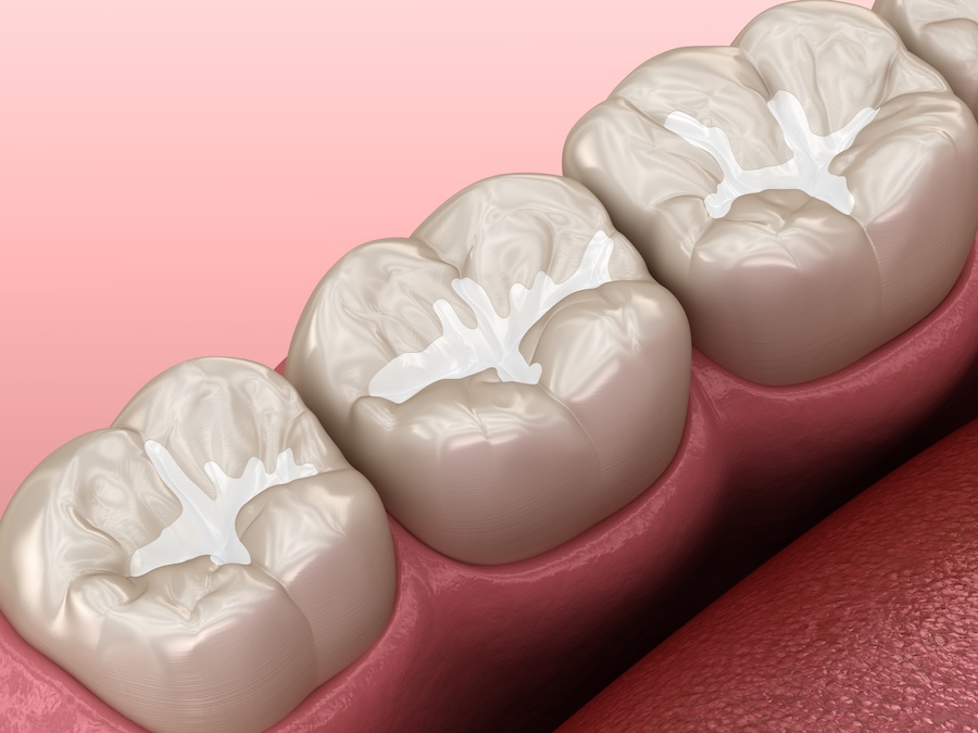 dental sealants on mandibular molar teeth to prevent cavities