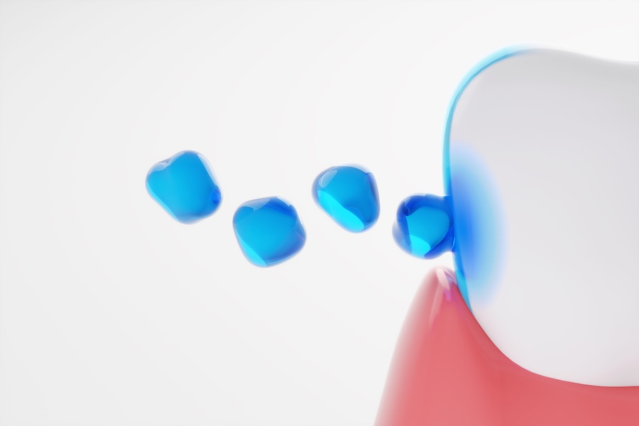 fluoride treatment on tooth to prevent decay