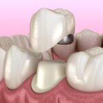 dental crowns