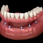 implant supported overdenture