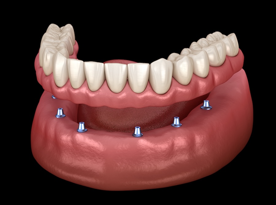 implant supported overdenture