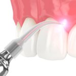 laser gum therapy aftercare
