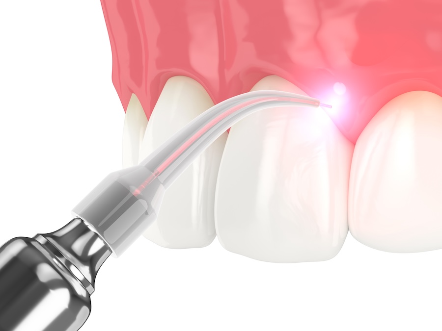 laser gum therapy aftercare