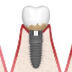 tender dental implant, stages of peri implantitis mucositis