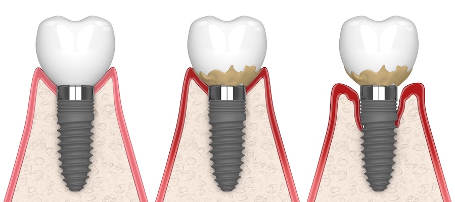 tender dental implant, stages of peri implantitis mucositis